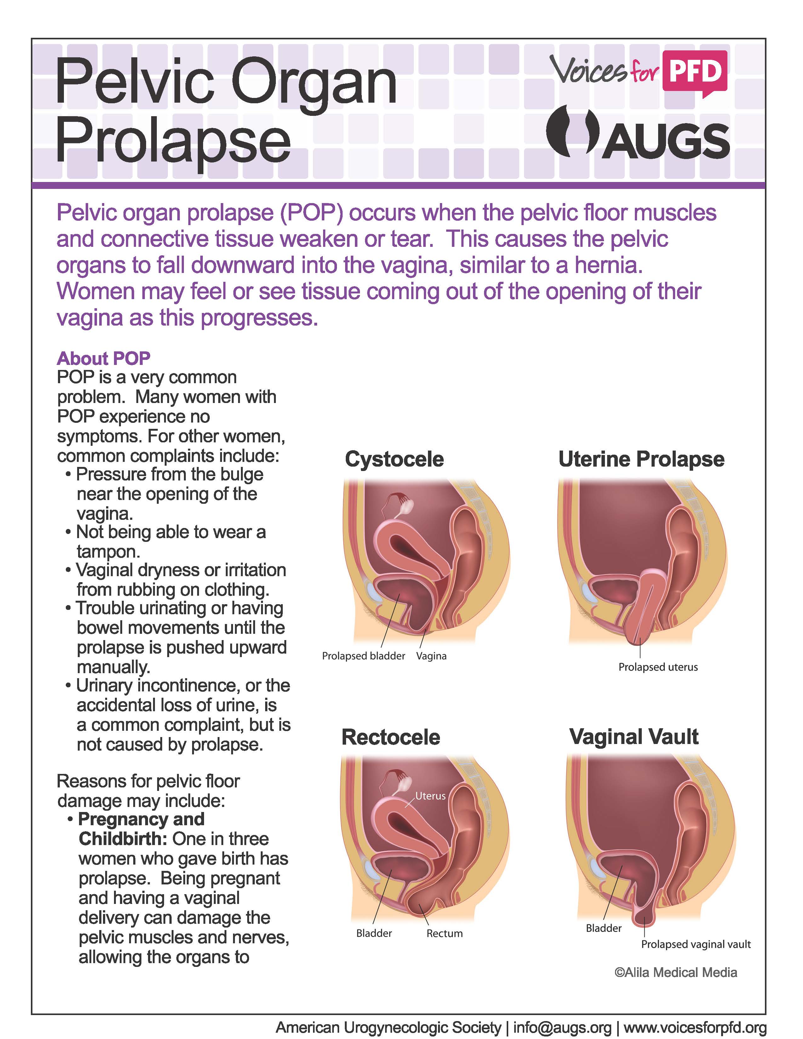 Diagnose And Treat A Prolapsed Bladder Urinary Incontinence Pelvic